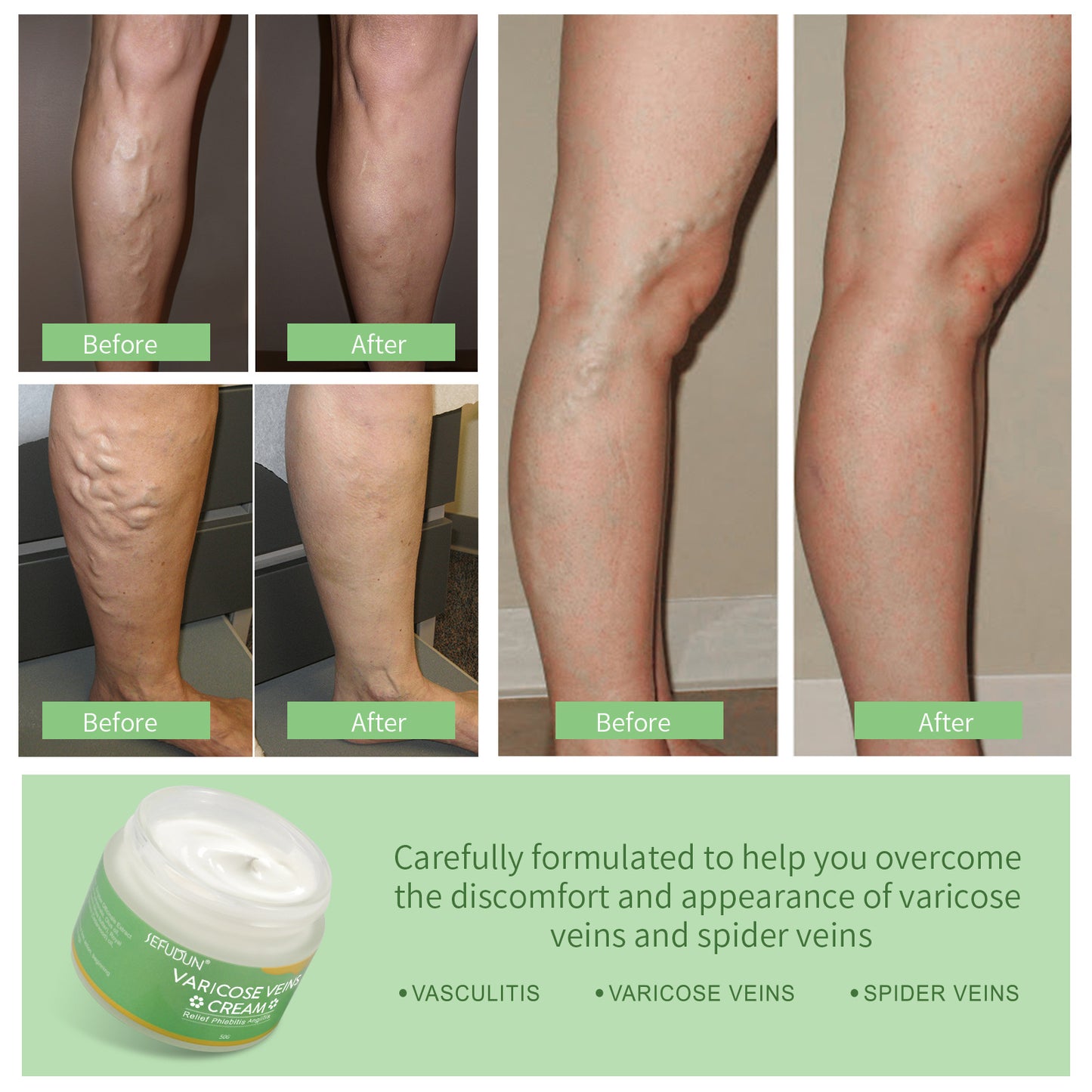 Vein Care Cream Red Blood Streaks Relief Safflower Skin Repair Varicose & Bruise Cream